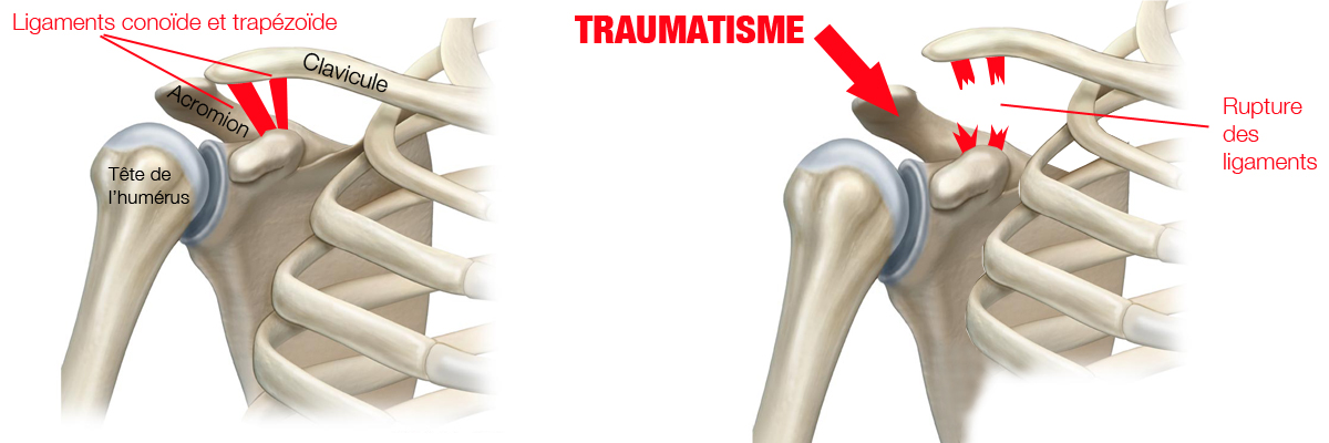 artroza deformantă a articulației acromioclaviculare dureri articulare și inflamații