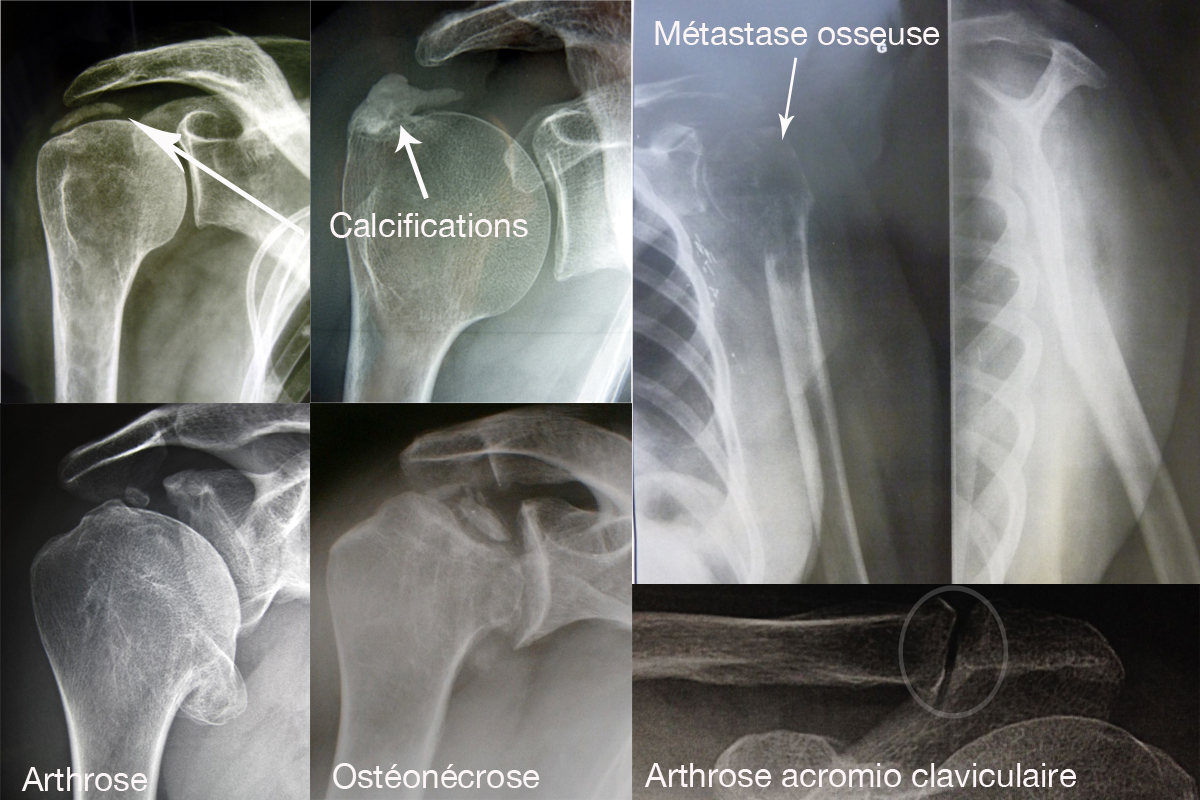 Radiographies | Le site de l'épaule
