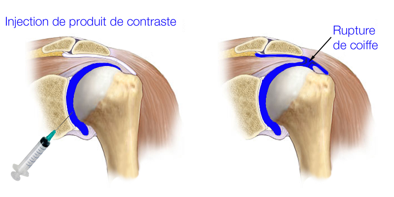 Arthro-scanner | Le site de l'épaule