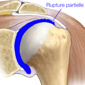 Rupture partielle